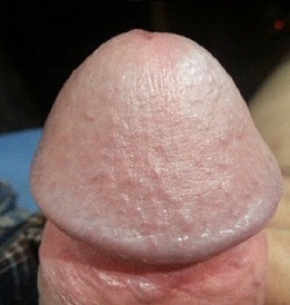Fotó a megnagyobbodott hüvelyi péniszről