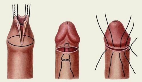 a pénisznövelő műtét lényege