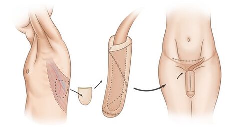 izomtranszplantáció a pénisz megnagyobbodása érdekében