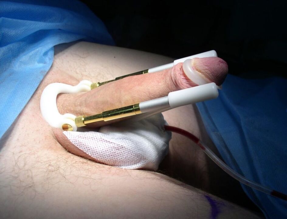 hosszabbító pénisznövelő műtét után