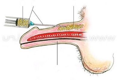 injekciós pénisz bővítés